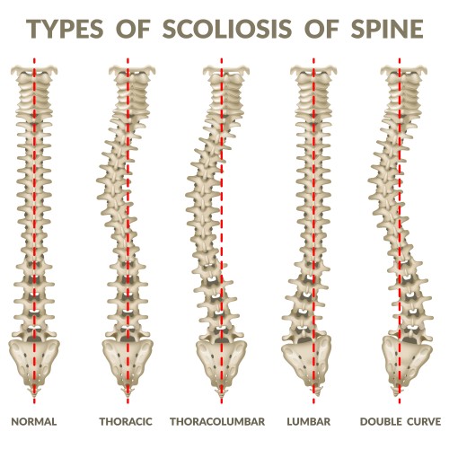 Scoliosis and Chiropractic Care
