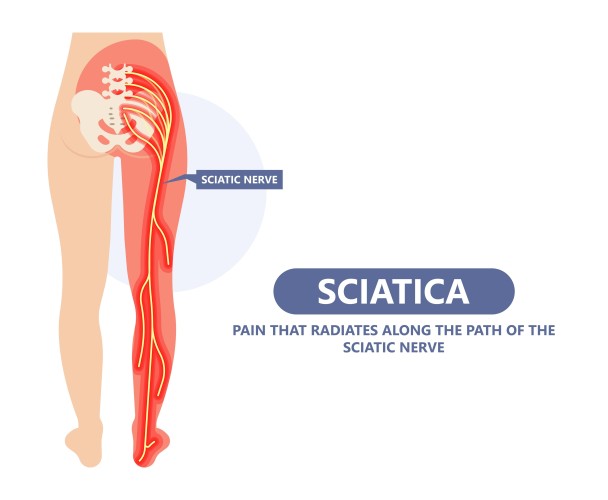 Think Chiropractor for Sciatica:  Sciatica Relief in Guildford Is Closer Than You Think